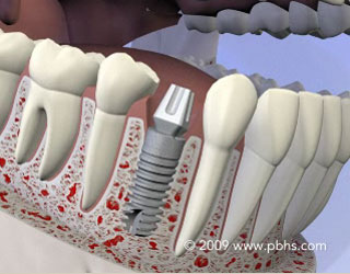 Dental Implants Illustration