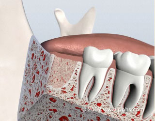 Wisdom Teeth Removal Illustration